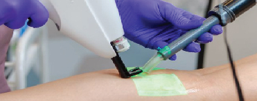 CLaCS Treatment